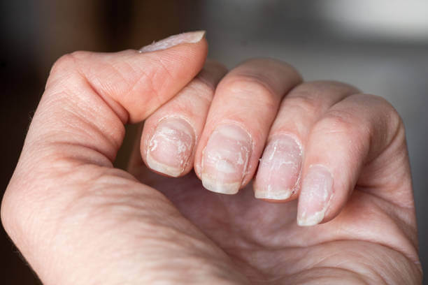 Acrylic Nail Infections